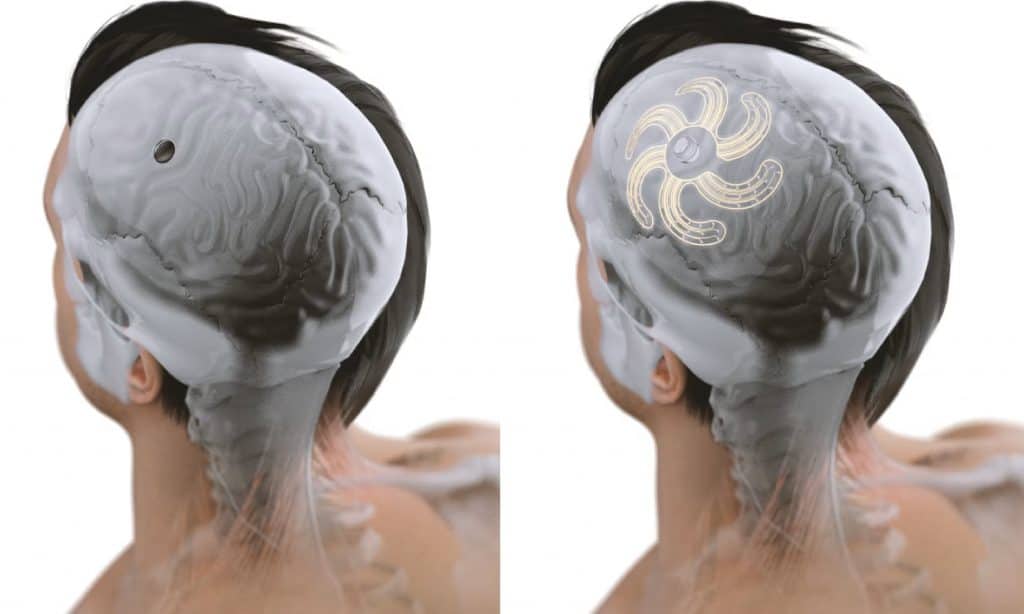 representação de implante cerebral da neurosoft
