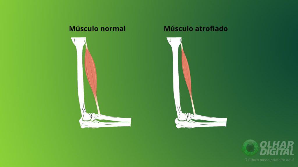 Atrofia muscular