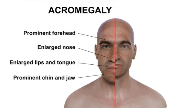 Ilustração mostrando quais as diferenças entre a acromegalia e uma pessoa sem a condição