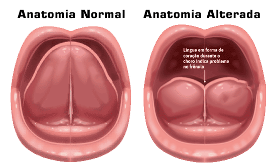 imagem mostra uma boca normal, e outra pessoa com que possui língua presa