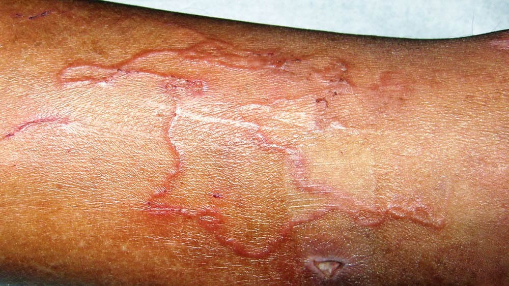 Bicho geográfico, larva migrans cutânea